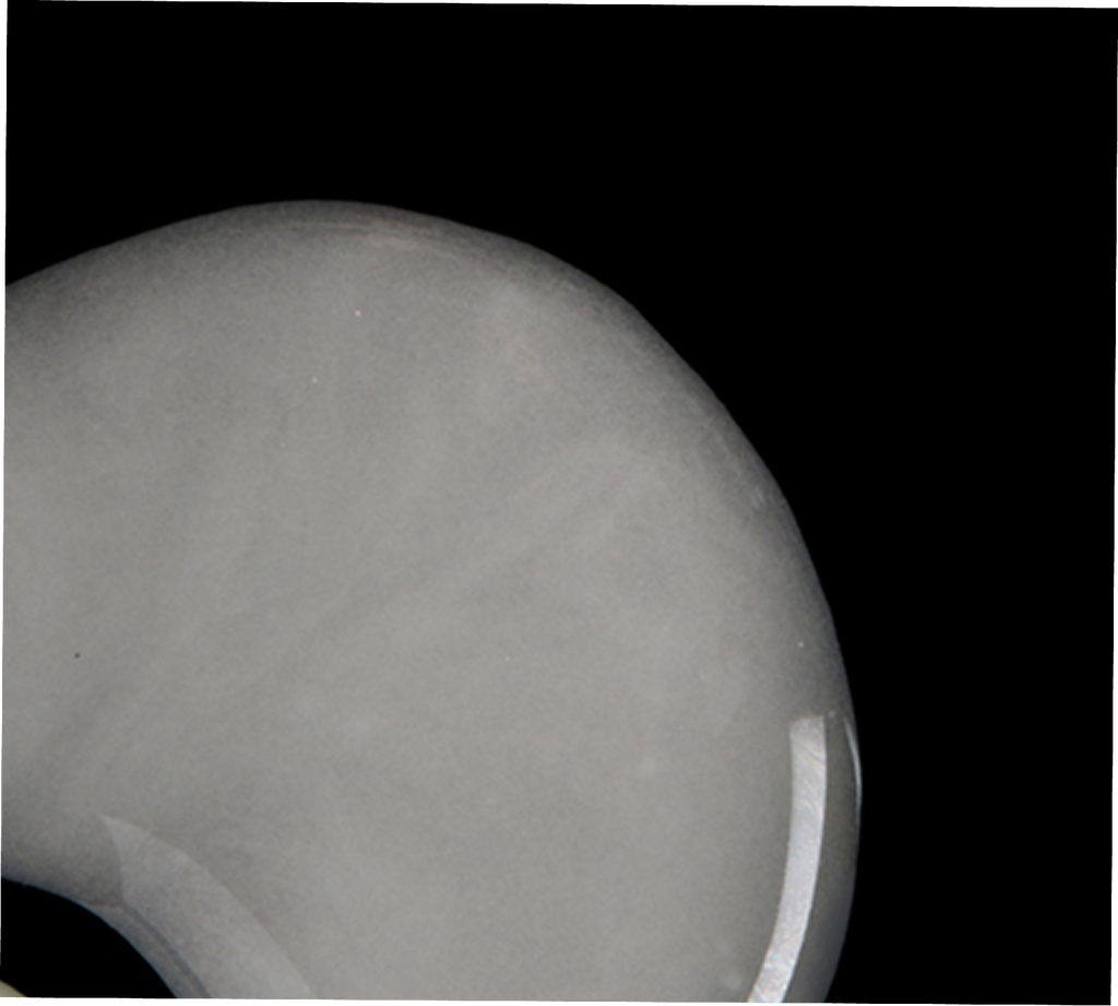 X-ray of a knee joint with a metallic component on a black background
