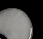 X-ray of a knee joint with a metallic component on a black background