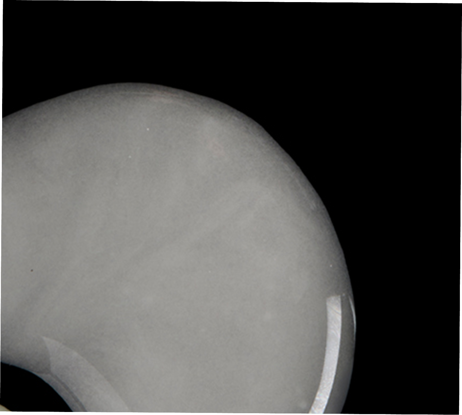 X-ray of a knee joint with a metallic component on a black background