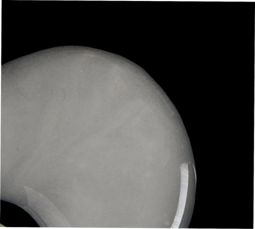 X-ray of a knee joint with a metallic component on a black background